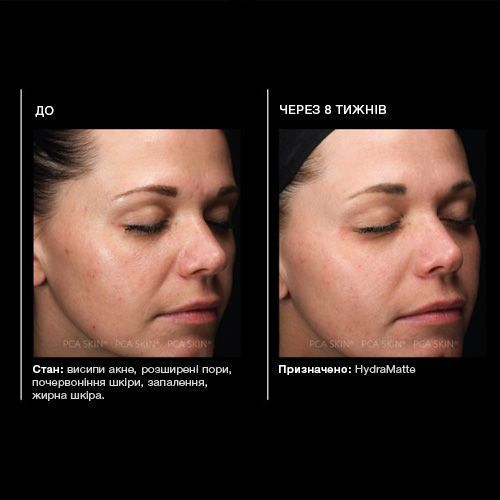PCA SKIN Hydramatte матуючий гель 69584325 фото