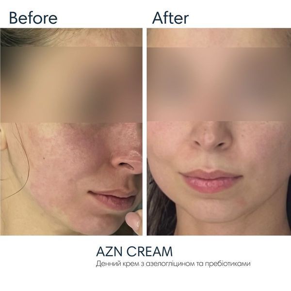 Braderm Azn Cream | Сонцезахисний крем з протизапальним ефектом 260954112 фото