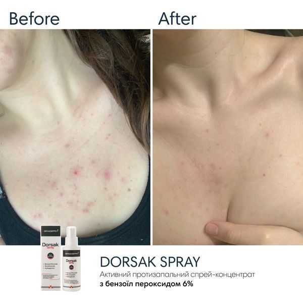 Braderm Dorsak Spray | Активний протизапальний спрей з Бензоїл пероксидом 6% 986003484 фото