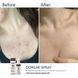Braderm Dorsak Spray | Активний протизапальний спрей з Бензоїл пероксидом 6% 986003484 фото 2