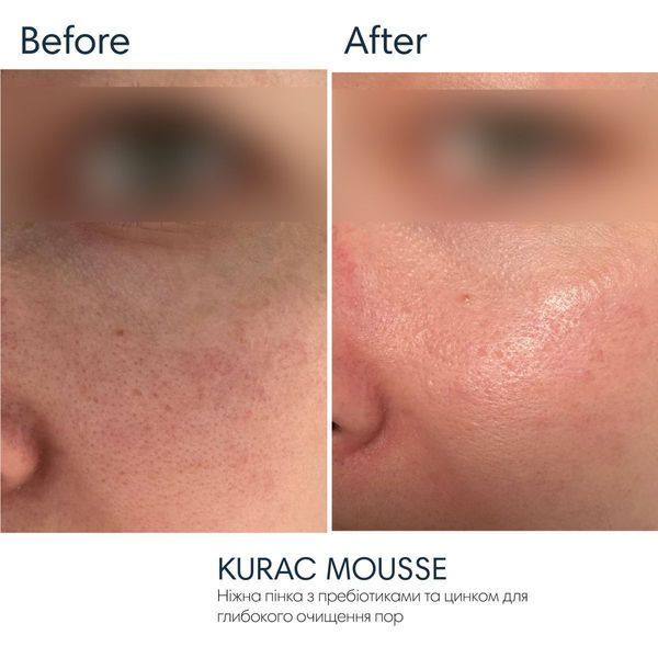 Braderm Kurac Mousse | Ніжна пінка для вмивання з пребіотиками 304154881 фото