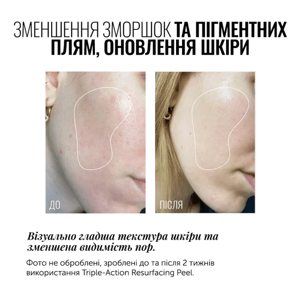 INSTYTUTUM ПІЛІНГ ДЛЯ ОБЛИЧЧЯ TRIPLE ACTION RESURFACING PEEL ПІЛІНГ ДЛЯ ОБЛИЧЧЯ ПОТРІЙНОЇ ДІЇ 0001001001 фото