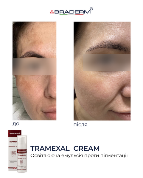 Braderm Tramexal Cream | Освітлюючий крем проти пігментації 971213669 фото