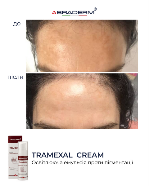Braderm Tramexal Cream | Освітлюючий крем проти пігментації 971213669 фото
