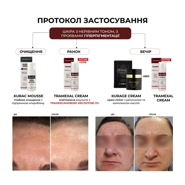 Braderm Tramexal Cream | Освітлюючий крем проти пігментації 971213669 фото