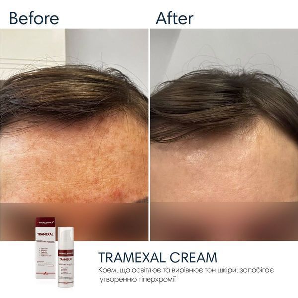 Braderm Tramexal Cream | Освітлюючий крем проти пігментації 971213669 фото