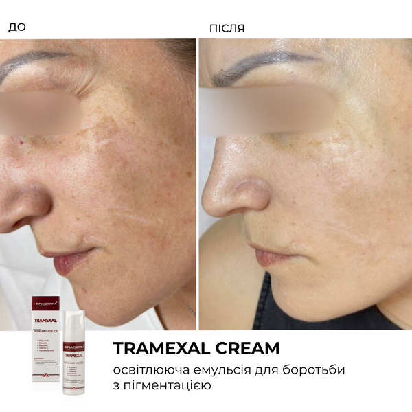 Braderm Tramexal Cream | Освітлюючий крем проти пігментації 971213669 фото