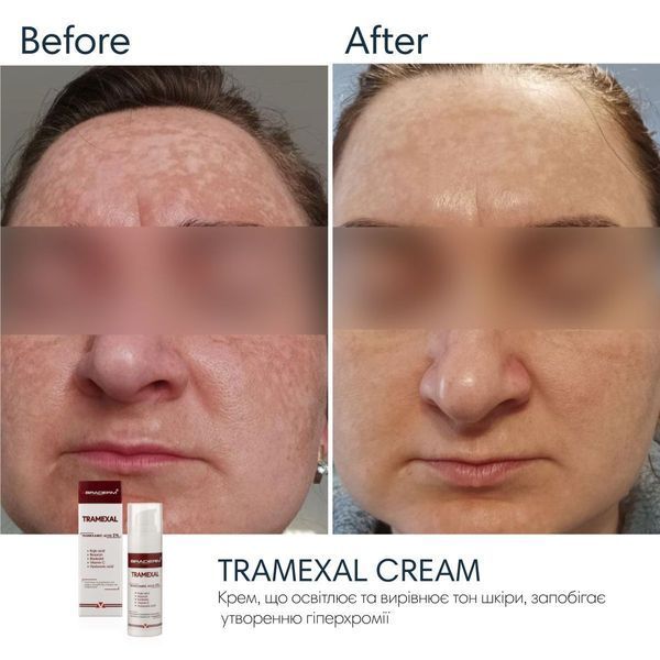 Braderm Tramexal Cream | Освітлюючий крем проти пігментації 971213669 фото