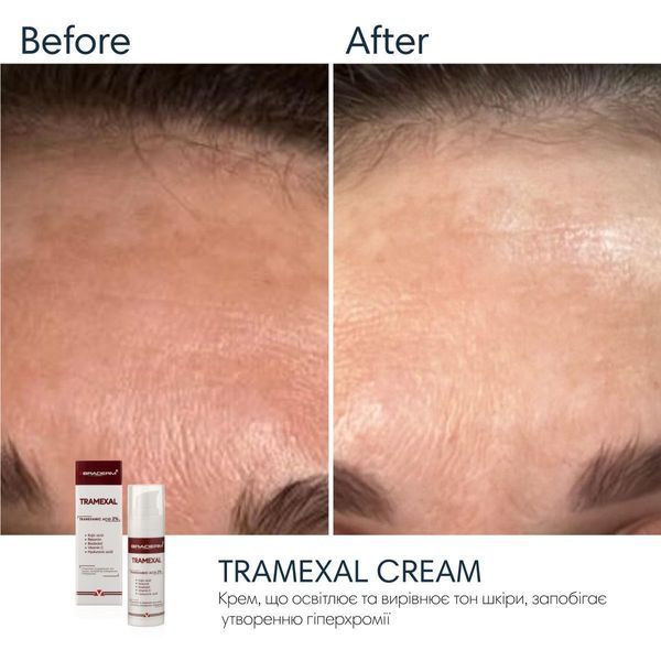 Braderm Tramexal Cream | Освітлюючий крем проти пігментації 971213669 фото