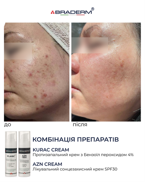 Braderm Kurac Cream | Активний протизапальний крем з бензоїл пероксидом 4% 106356892 фото