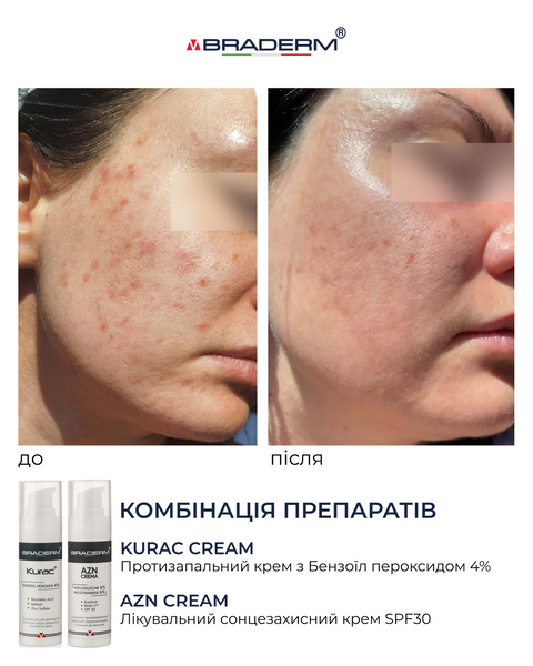 Braderm Kurac Cream | Активний протизапальний крем з бензоїл пероксидом 4% 106356892 фото