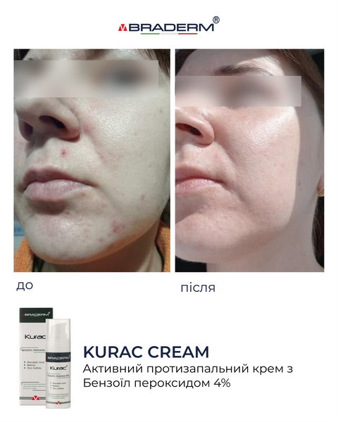 Braderm Kurac Cream | Активний протизапальний крем з бензоїл пероксидом 4% 106356892 фото