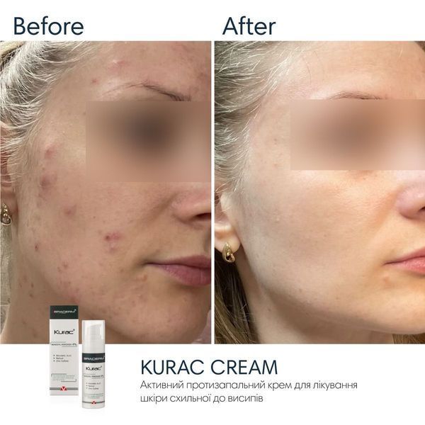 Braderm Kurac Cream | Активний протизапальний крем з бензоїл пероксидом 4% 106356892 фото