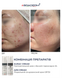 Braderm Kurac Cream | Активний протизапальний крем з бензоїл пероксидом 4% 106356892 фото 6